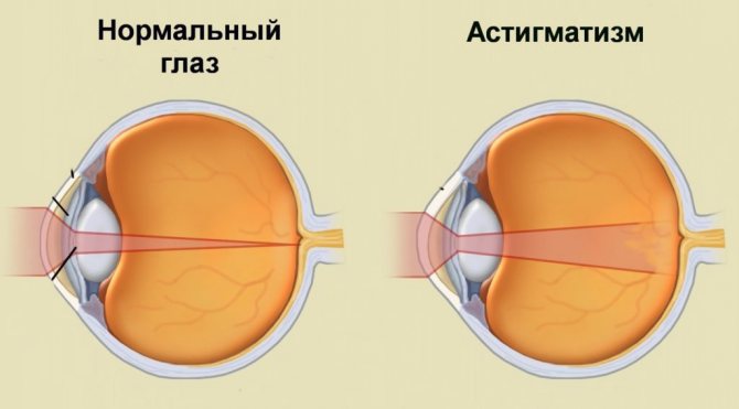 Что такое астигматизм