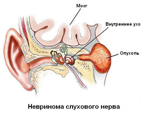 Невринома особенности и локализация опухоли