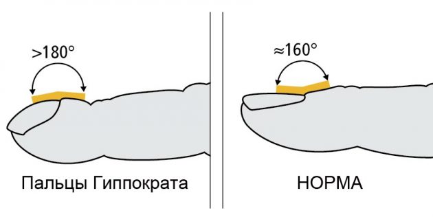 Пальцы Гиппократа